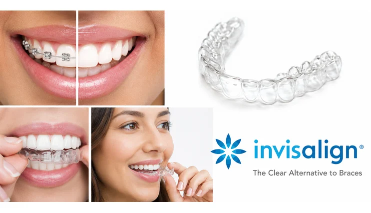 invisalign